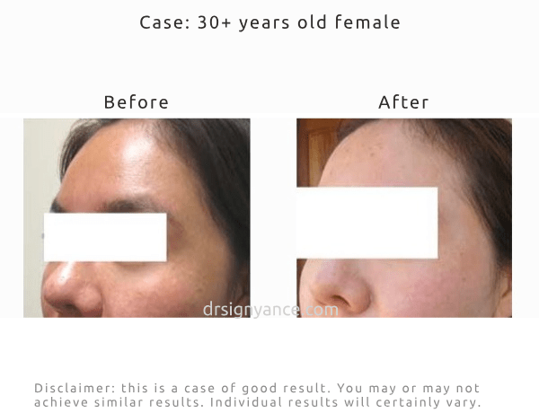 Before After pictures of brightening melasma spots