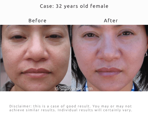 Before After pictures of brightening under eye dark circles and improving the look of sagging cheeks