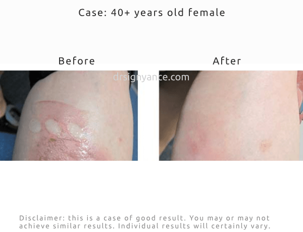 Before After pictures of improving the look of dark red pigmentation after a burn