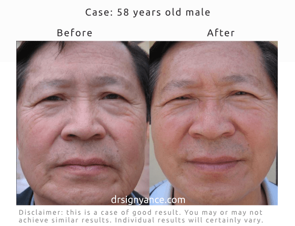 Before After pictures of anti sagging and anti wrinkles