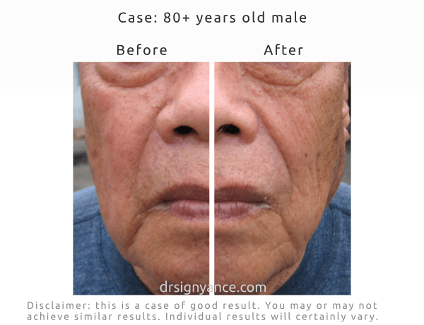 Before After frontal pictures of improving the look of sagging skin and deep wrinkles