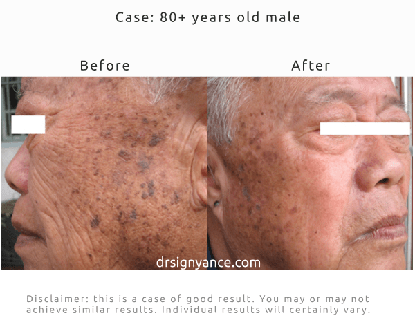 Before After pictures of improving the look of sagging skin and deep wrinkles