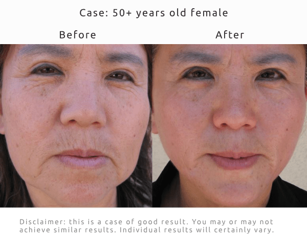 Before After frontal pictures of improving the look of sagging skin and deep wrinkles