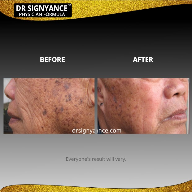 Before After picture #2 for men's anti aging, Dr Signyance physician formulated skincare