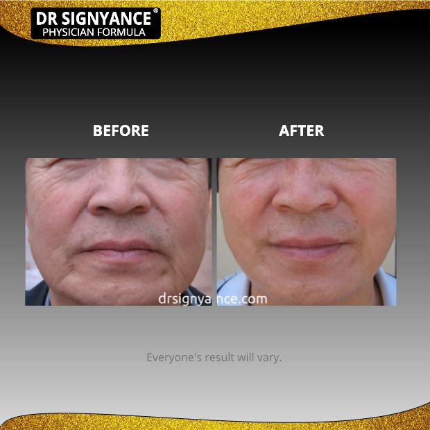 Before After picture for men's anti aging, Dr Signyance physician formulated skincare
